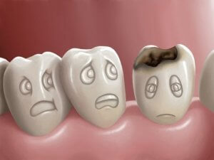 What Are Dental Cavities and How Can They Be Prevented?