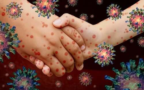 Lack of Vaccination and Increased Cases of the Measles