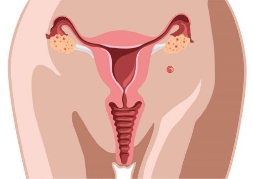 What's Hysterosalpingography (HSG)?