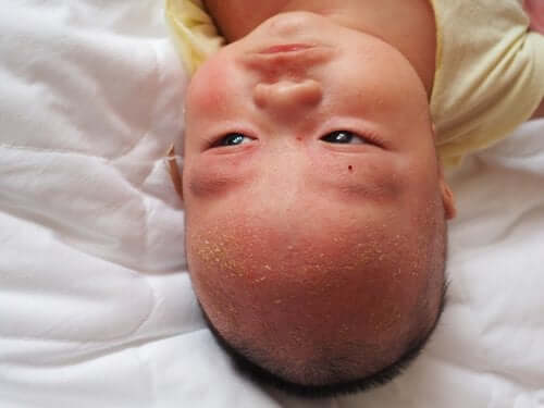 Interesting Facts About Cradle Cap