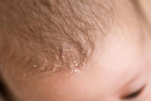 Interesting Facts About Cradle Cap