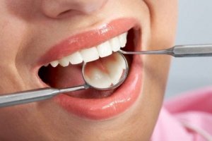 How to Prevent Tooth Decay with Fluoride