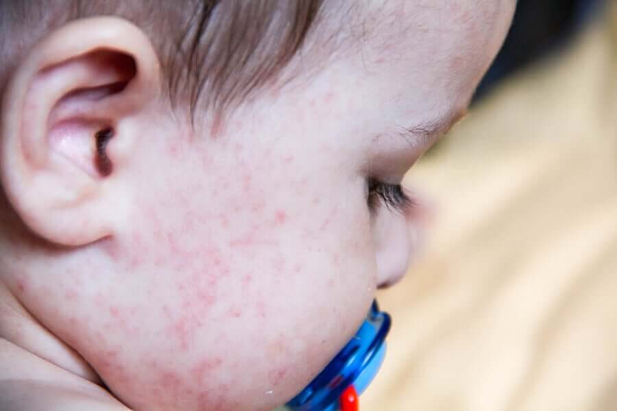 Roseola in Children: What You Need To Know