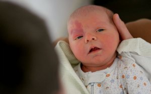 Sturge-Weber Syndrome in Children