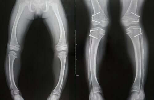 Rickets: Vitamin D Deficiency in Children