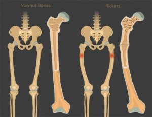 Rickets: Vitamin D Deficiency in Children