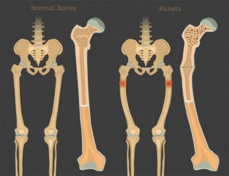 Calcium Rickets Rickets: Vitamin D Deficiency in Children - You are Mom