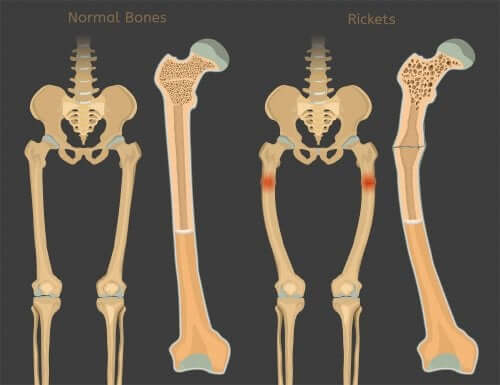 Rickets: Vitamin D Deficiency in Children - You are Mom