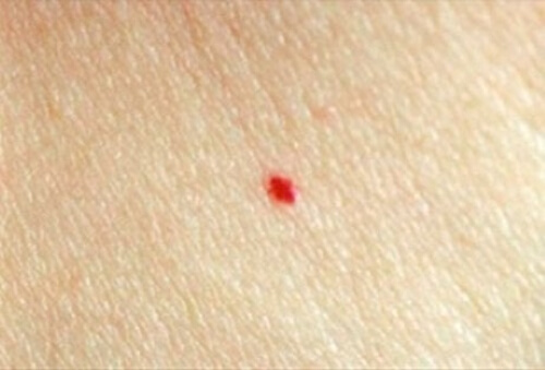 Infant Hemangiomas: Common Tumors in Infants