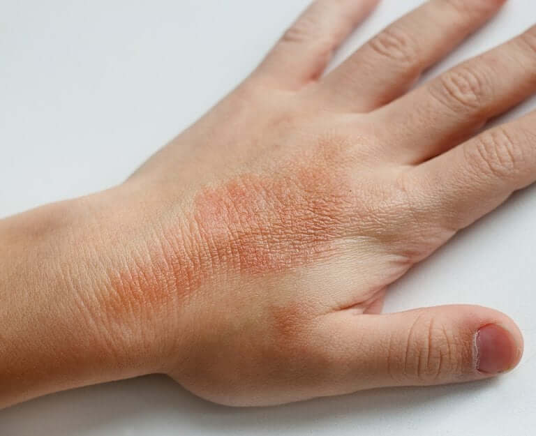 pinpoint rash on hands