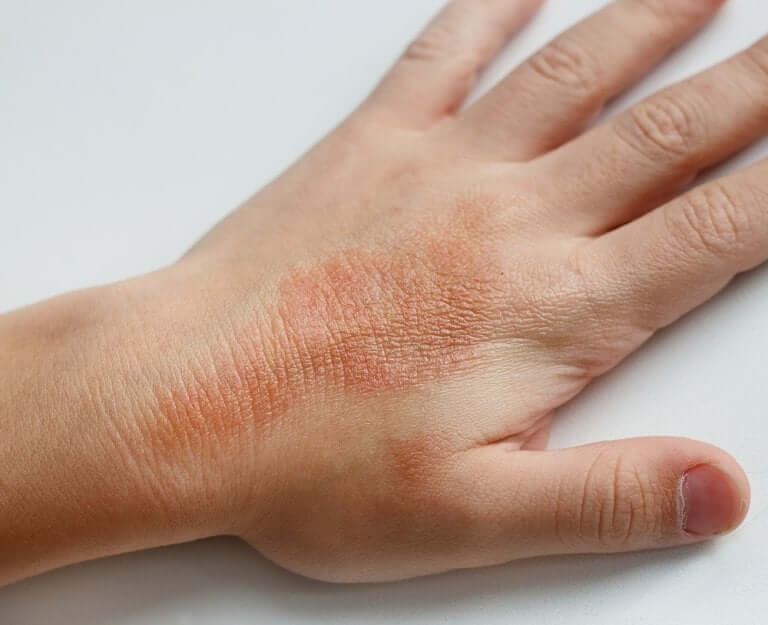 What Is Juvenile Dermatomyositis?
