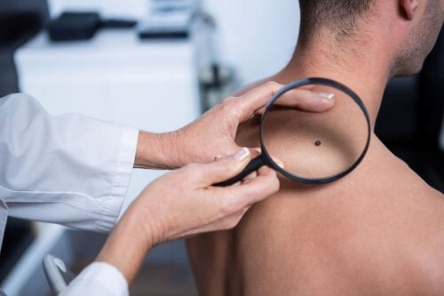 How to Recognize when Moles Are Cancerous