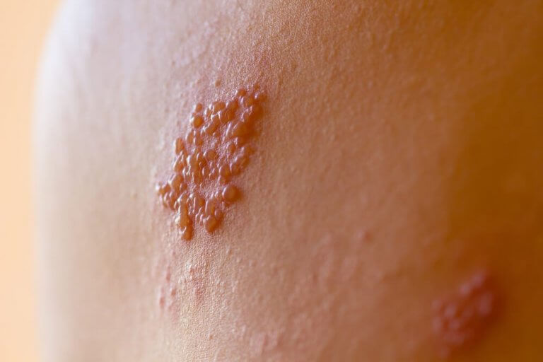 Herpes Zoster in Children: What You Should Know