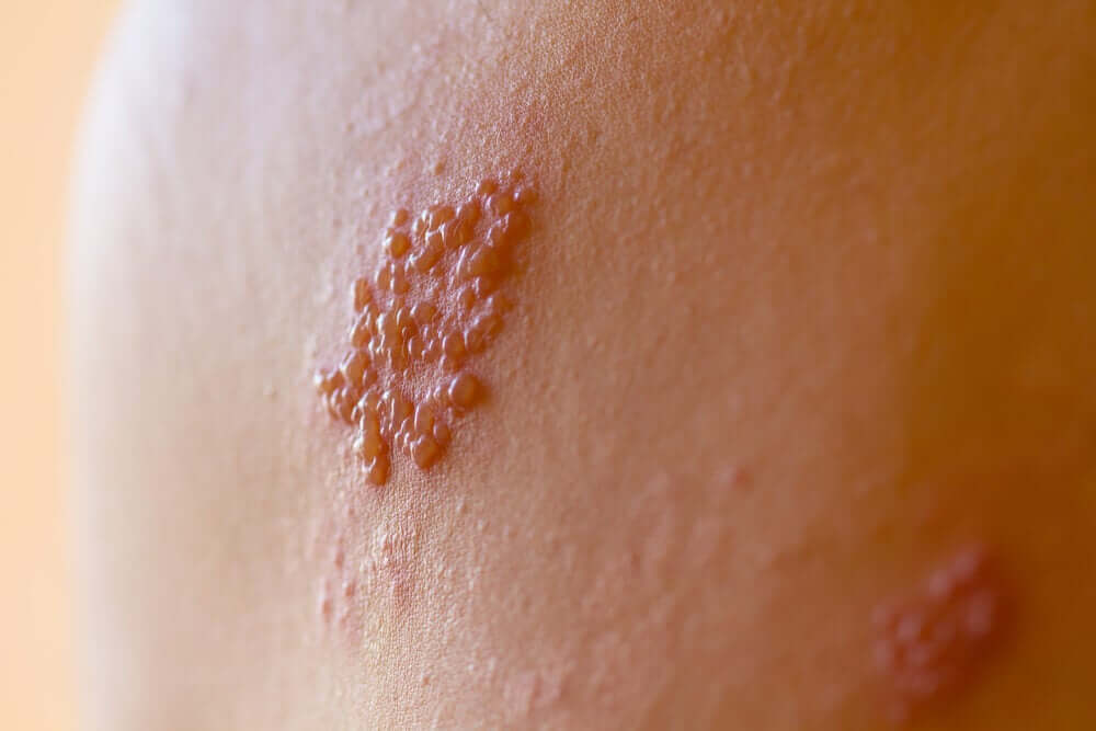 Herpes Zoster in Children: What You Should Know