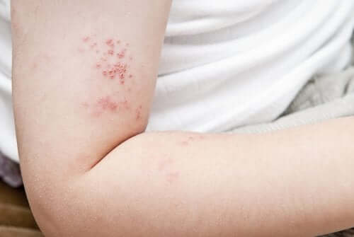 Herpes zoster outbreak on an arm.