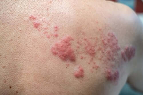 Outbreak of herpes zoster on an adult back.