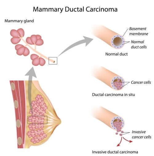 The Biology of Breast Cancer: Origin and Types