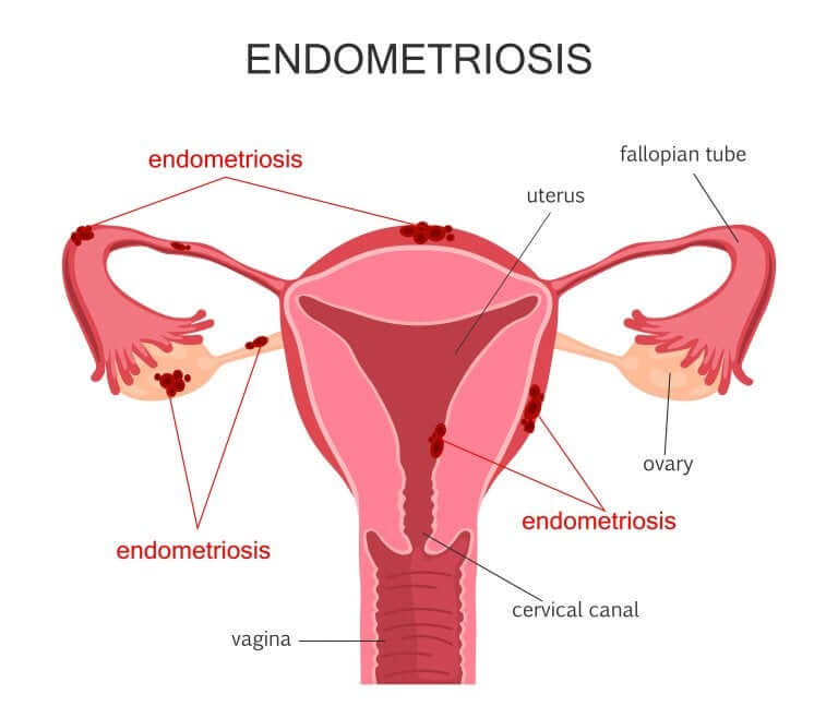 Uterine Cancer and the Human Papillomavirus Infection