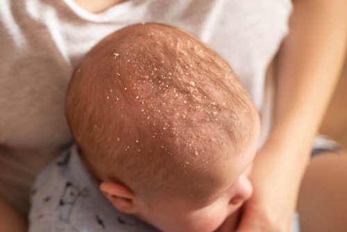10 vanligste hudsykdommer hos babyer