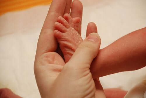 Seborrheic Dermatitis in Children