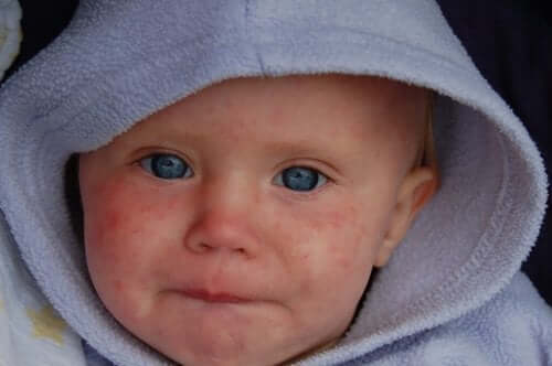 A baby with the measles.