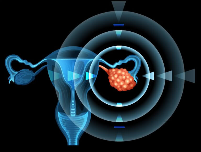 Is Ovarian Cancer Hereditary?