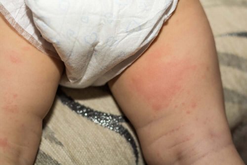 Seborrheic Dermatitis in Children