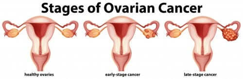 The stages of ovarian cancer.