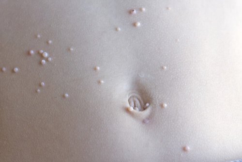 What to Do If Your Child Has Molluscum Contagiosum (MC)