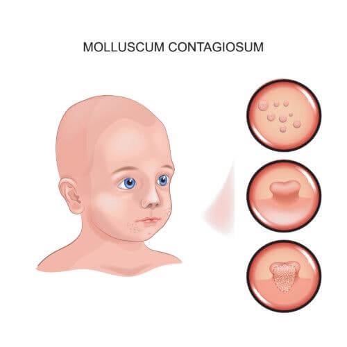 What to Do If Your Child Has Molluscum Contagiosum (MC)
