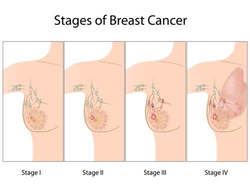 The Development of Breast Cancer