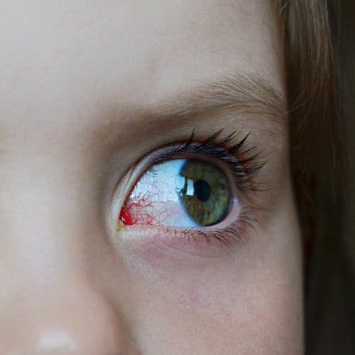 How to Detect and Treat Glaucoma in Children