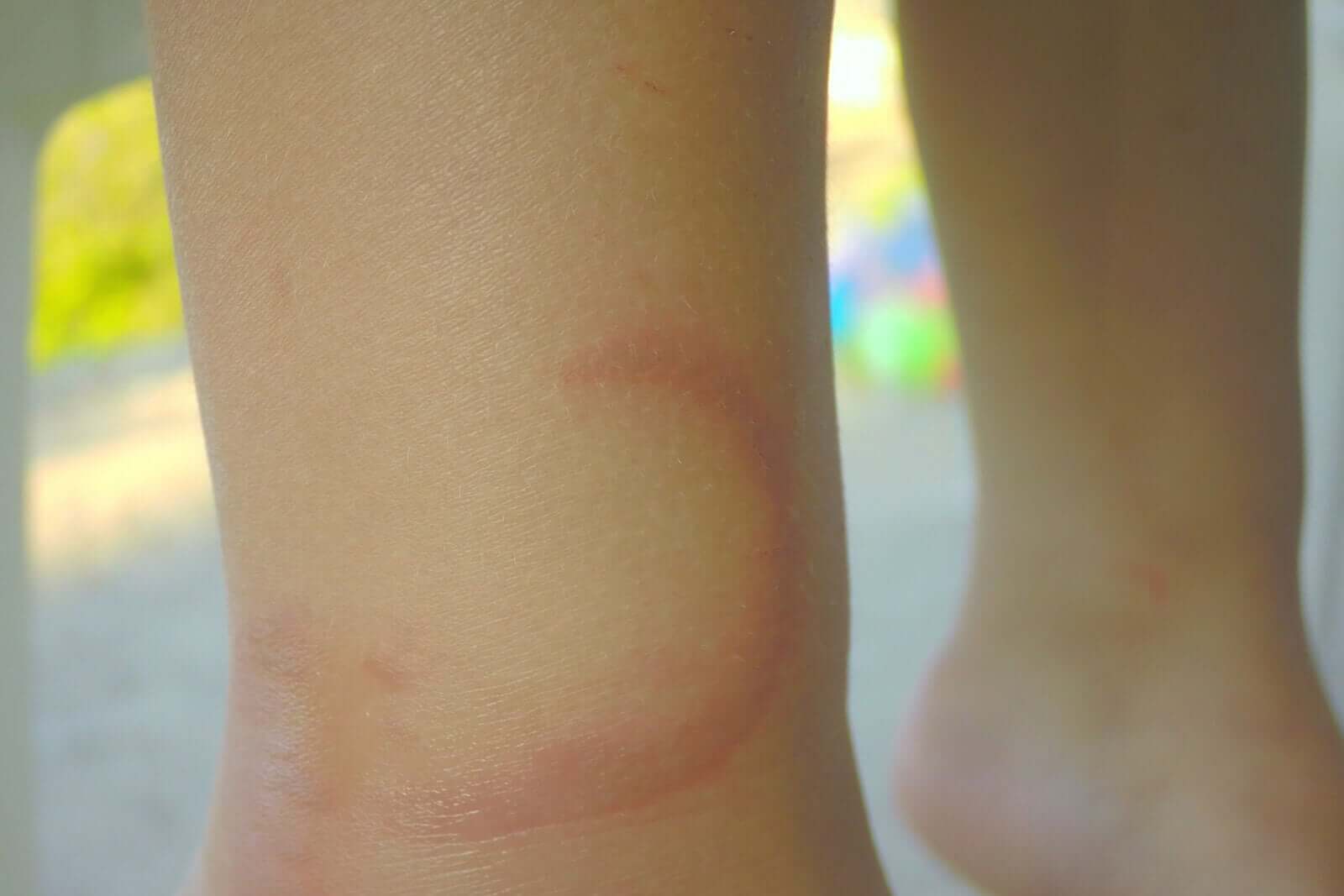 Jellyfish Stings in Children: What You Need to Know