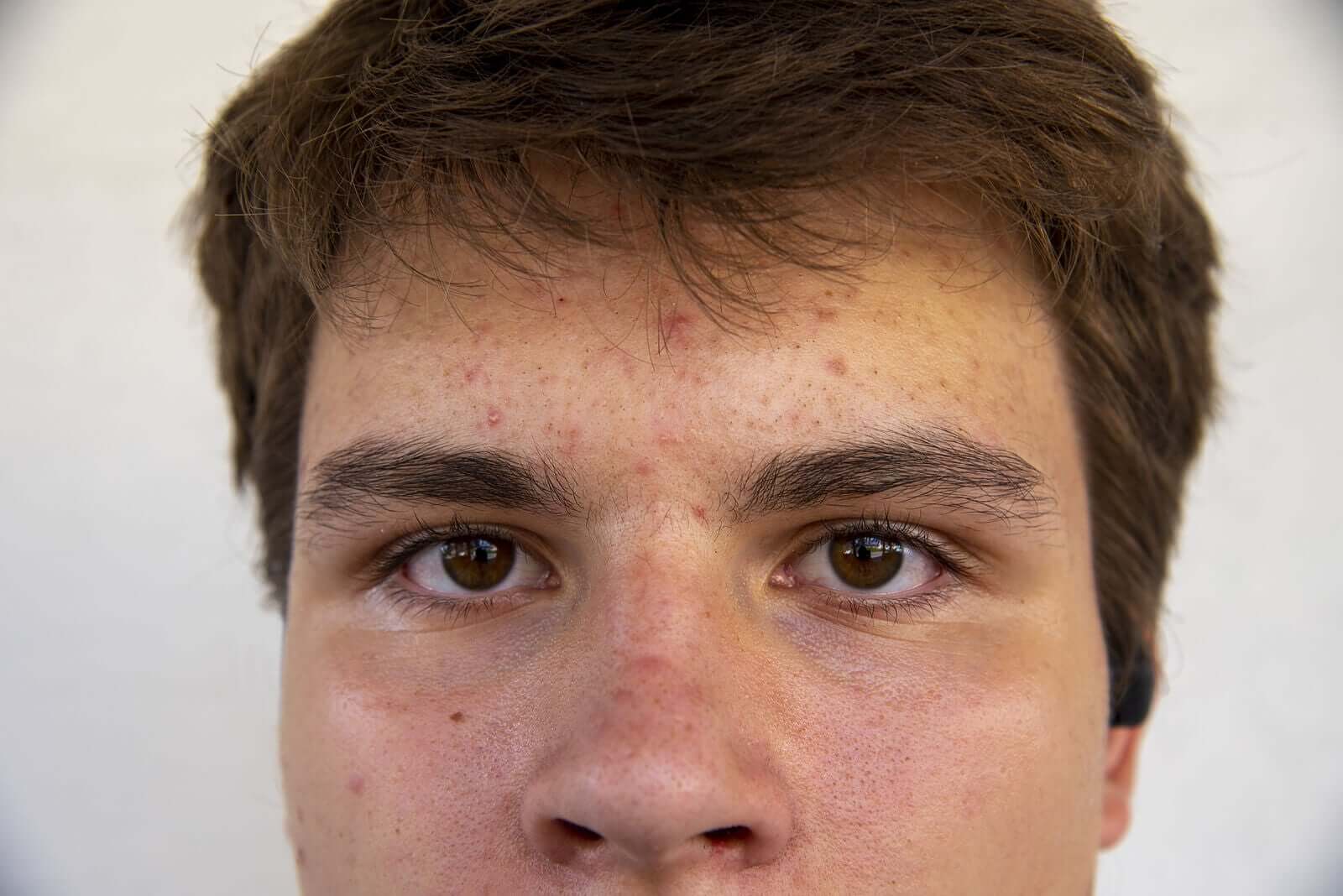 Teenage Acne: Types and Causes