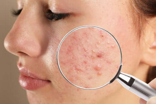 Teenage Acne: Types and Causes