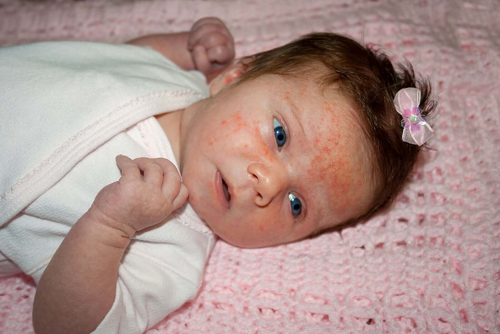 Eczema in Babies: Characteristics and Treatment