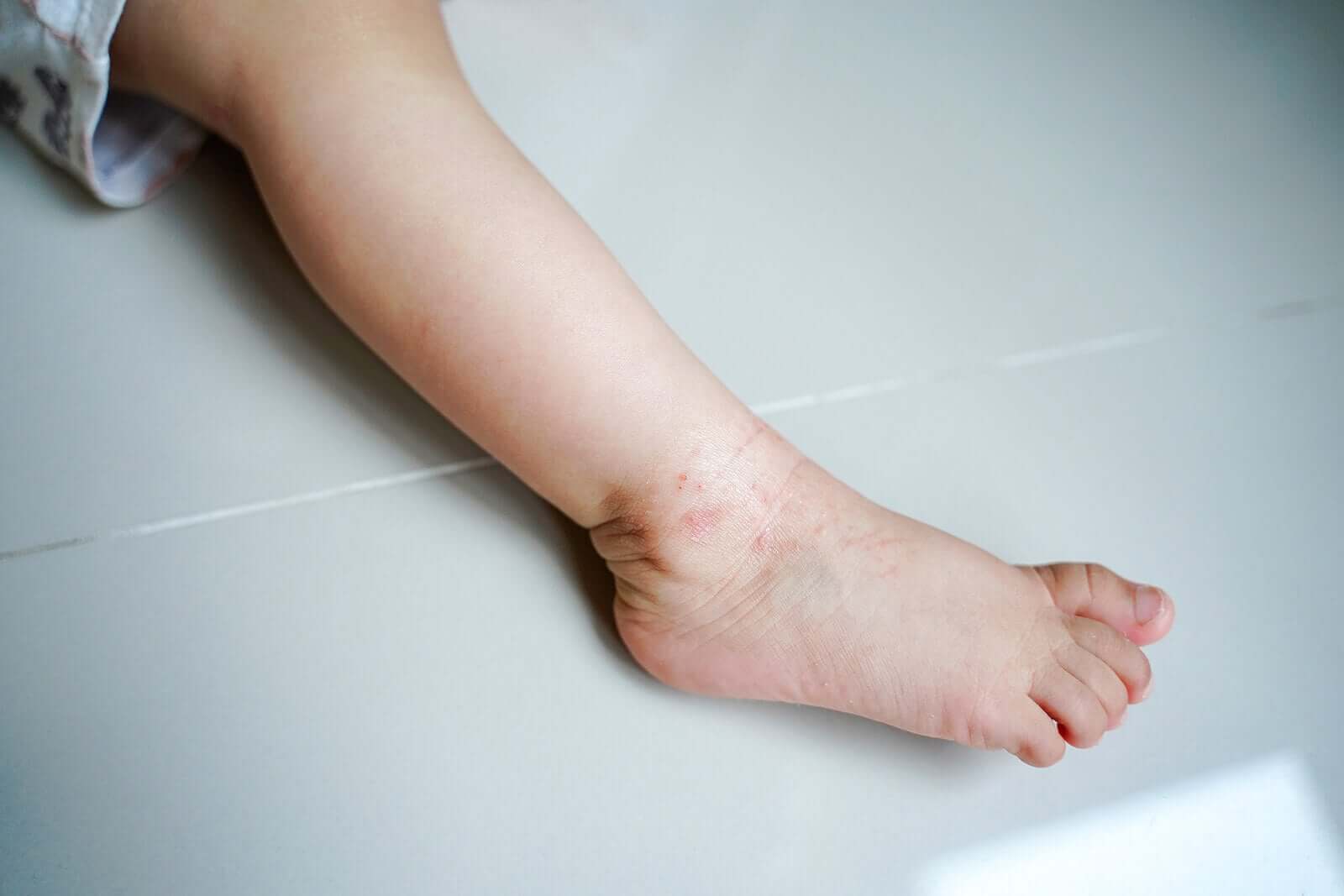 Eczema in Babies: Characteristics and Treatment
