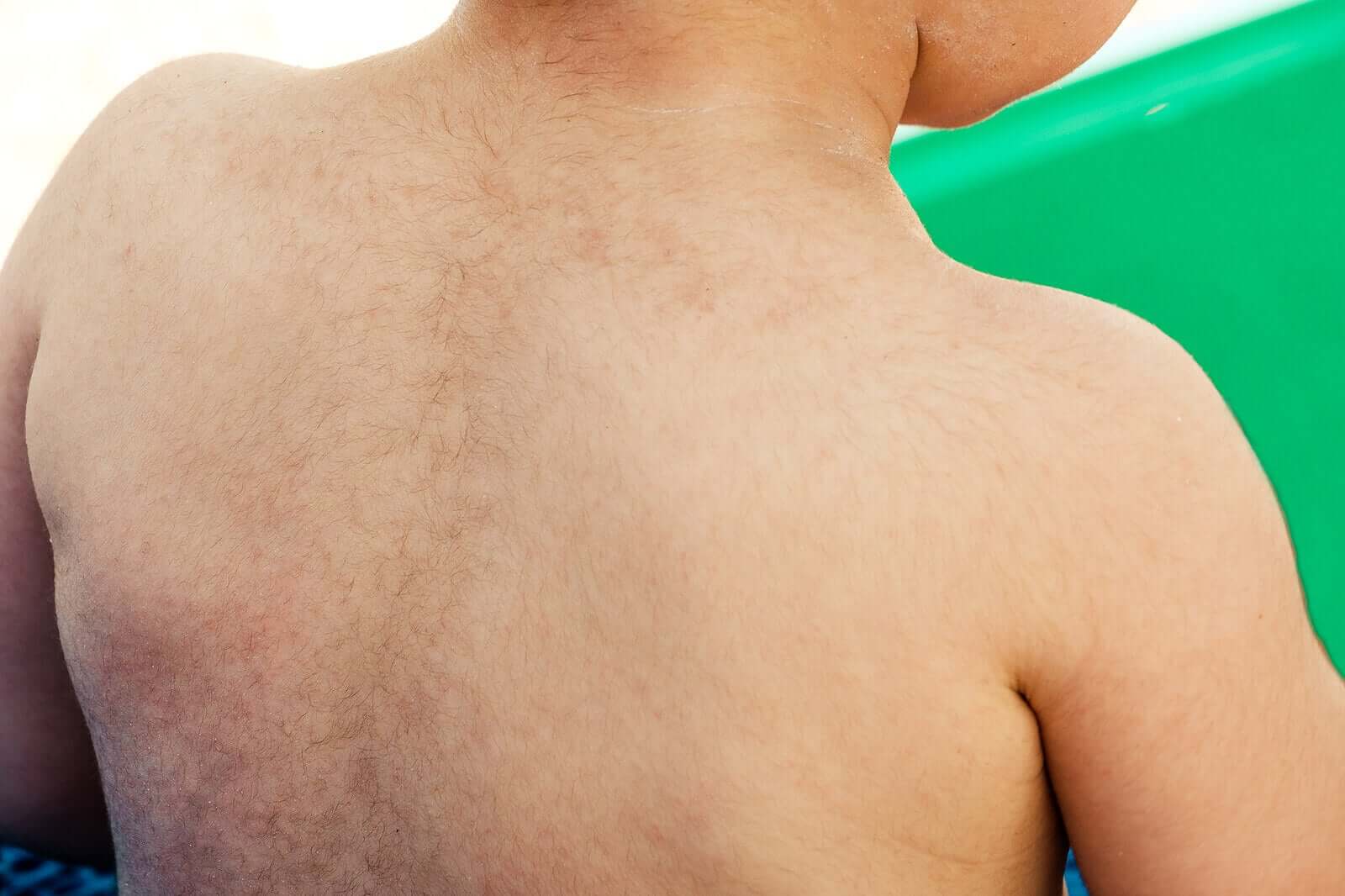 Hirsutism or Excessive Hair Growth in Children