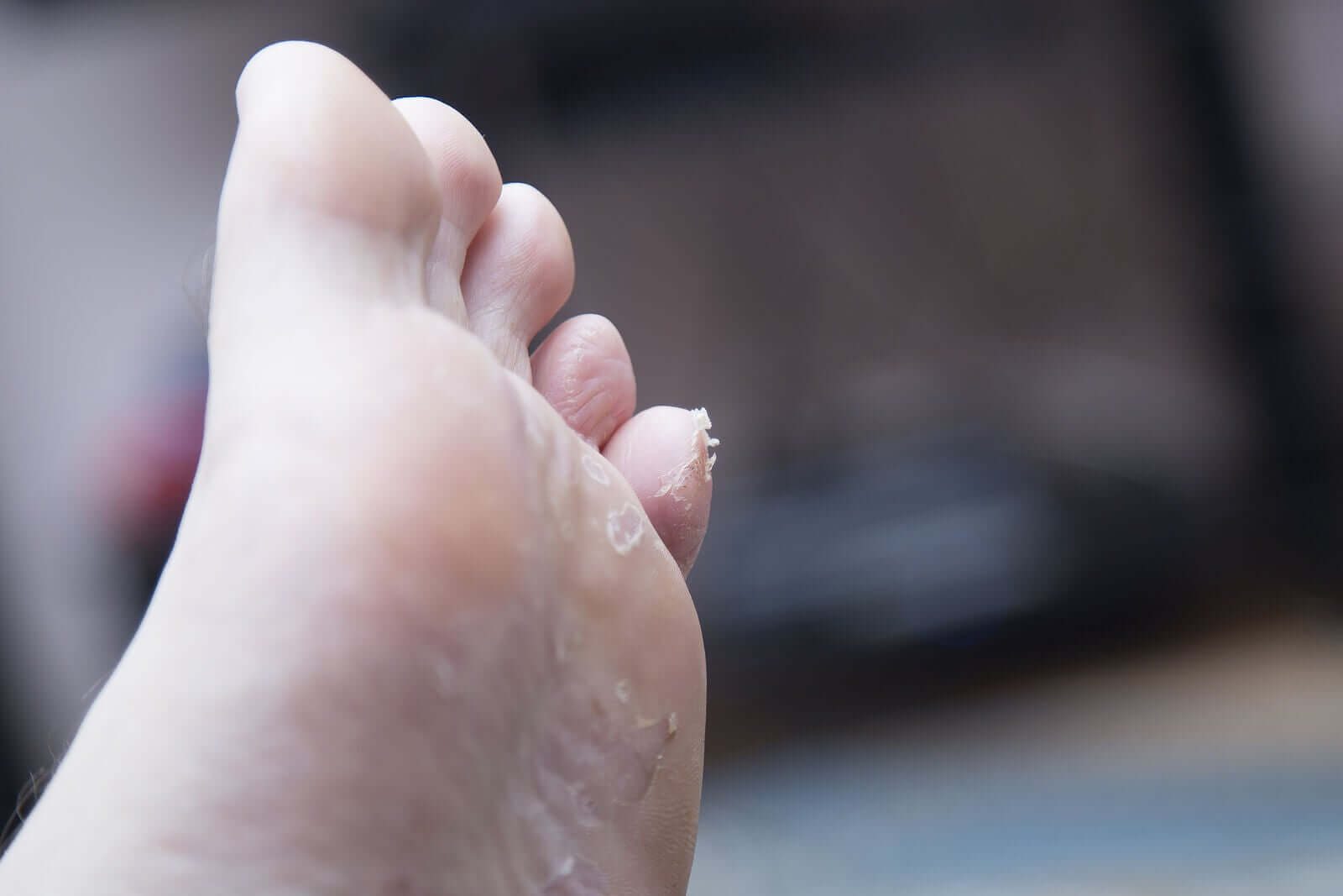 Juvenile Plantar Dermatitis: What You Should Know