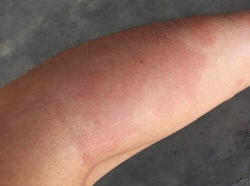 Systemic Lupus Erythematosus in Children