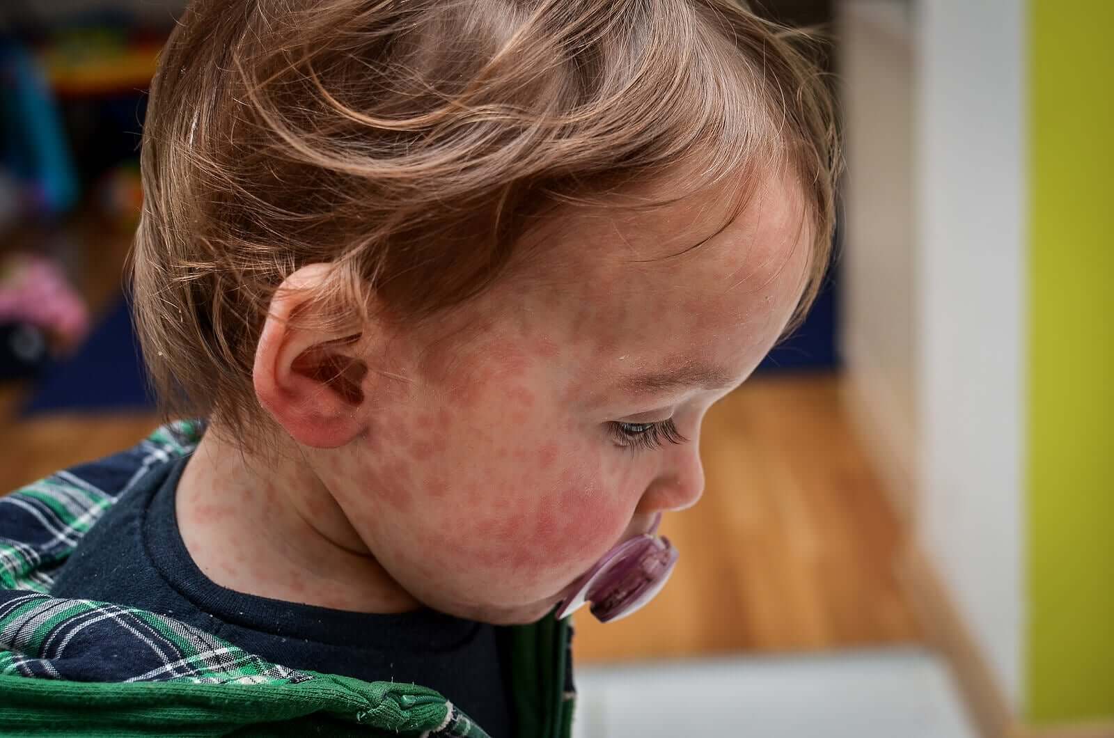 The Relationship Between Food and Eczema in Babies