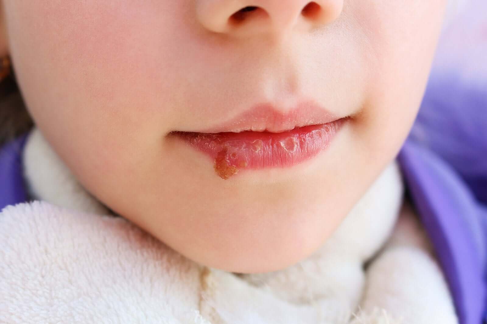 Ett barn med ett munsår i munnen.