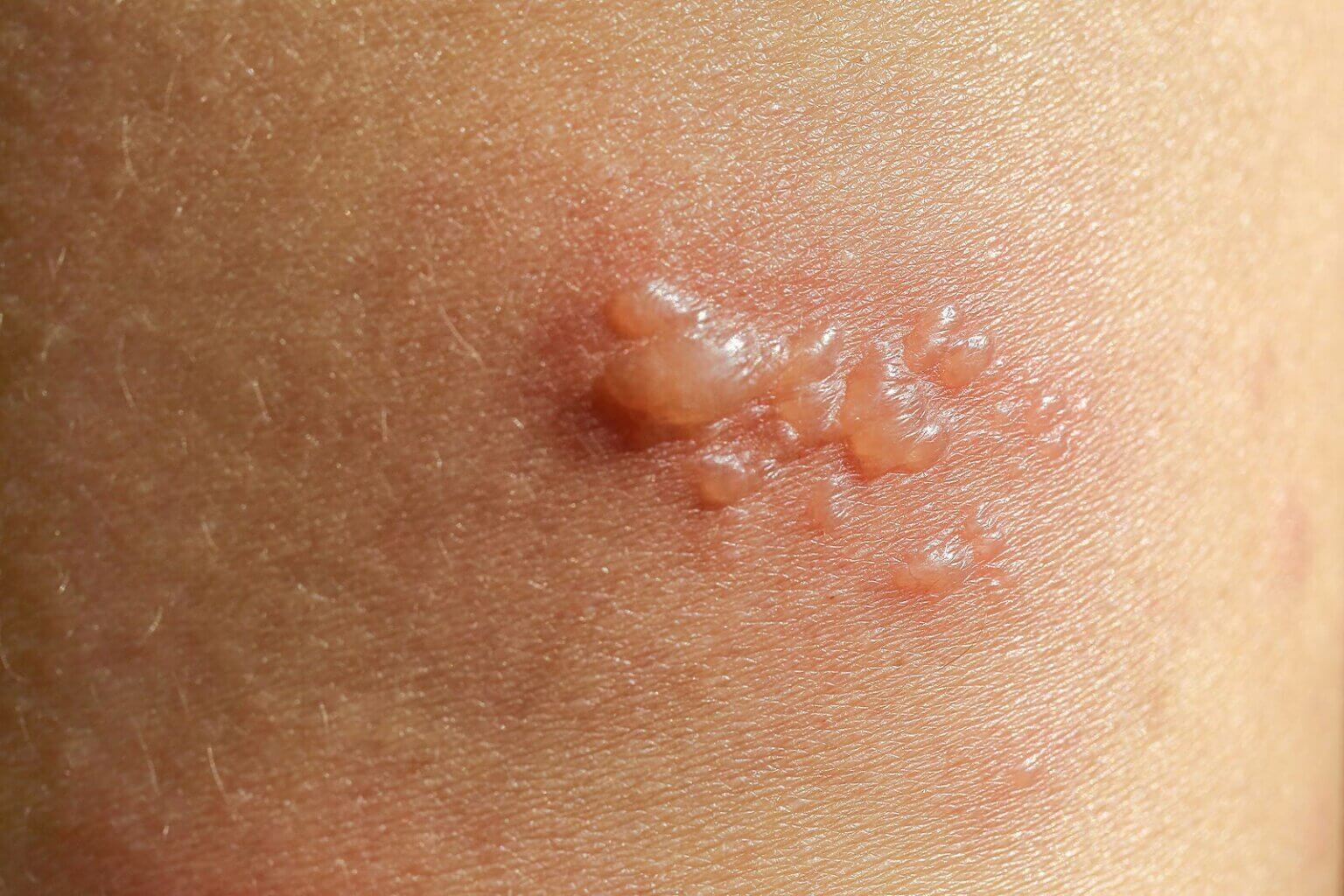 Gestational Pemphigoid During Pregnancy You Are Mom gestational-pemphigoid-during-pregnancy-you-are-mom