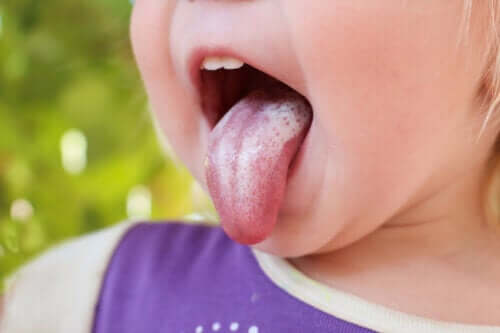 Oral Candidiasis in Children: Symptoms, Causes and Treatment
