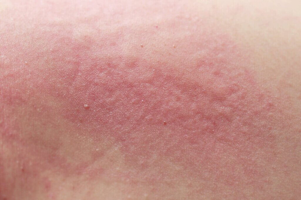 Scabies in Children: Symptoms, Causes and Treatment - You are Mom