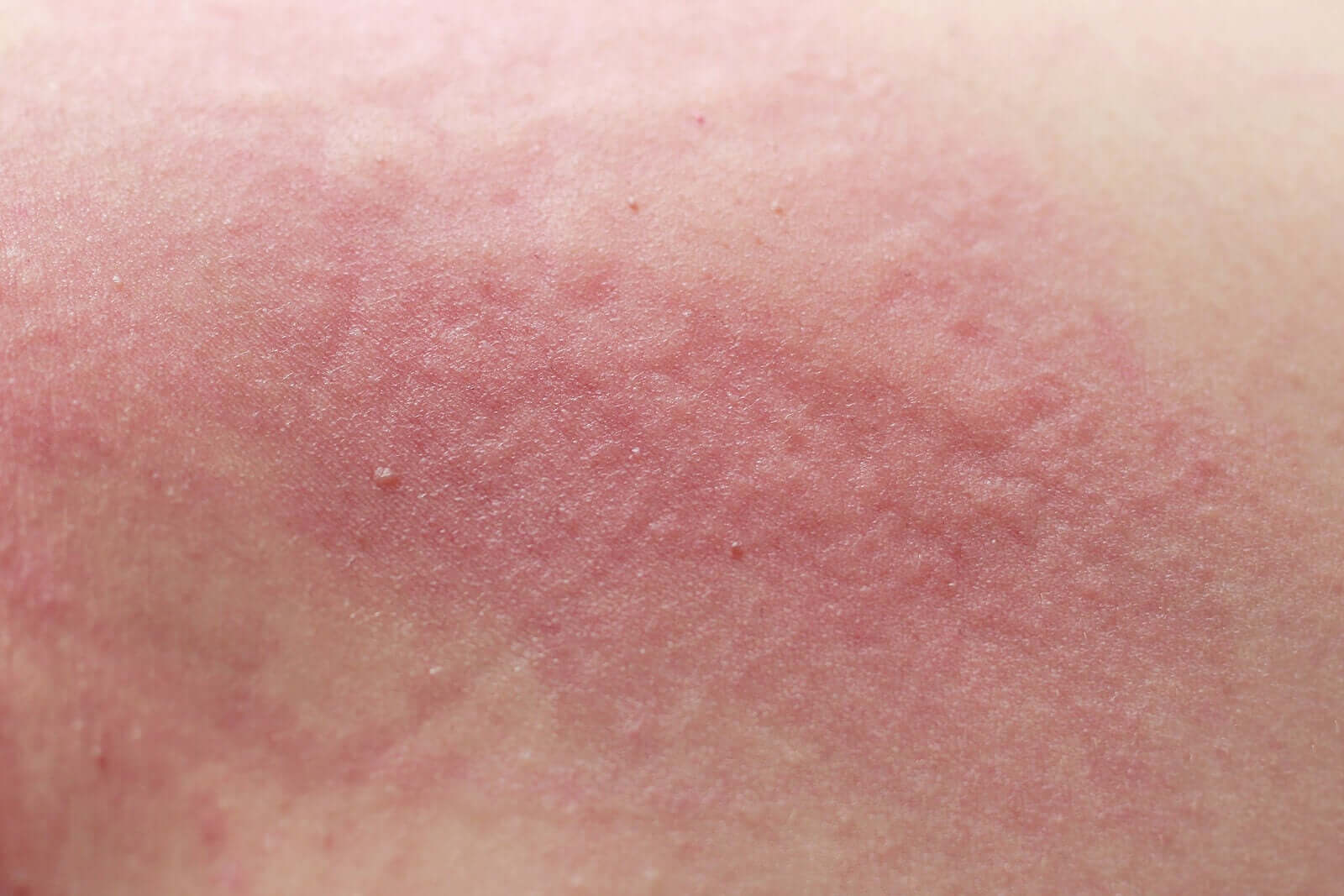 Scabies in Children: Symptoms, Causes and Treatment
