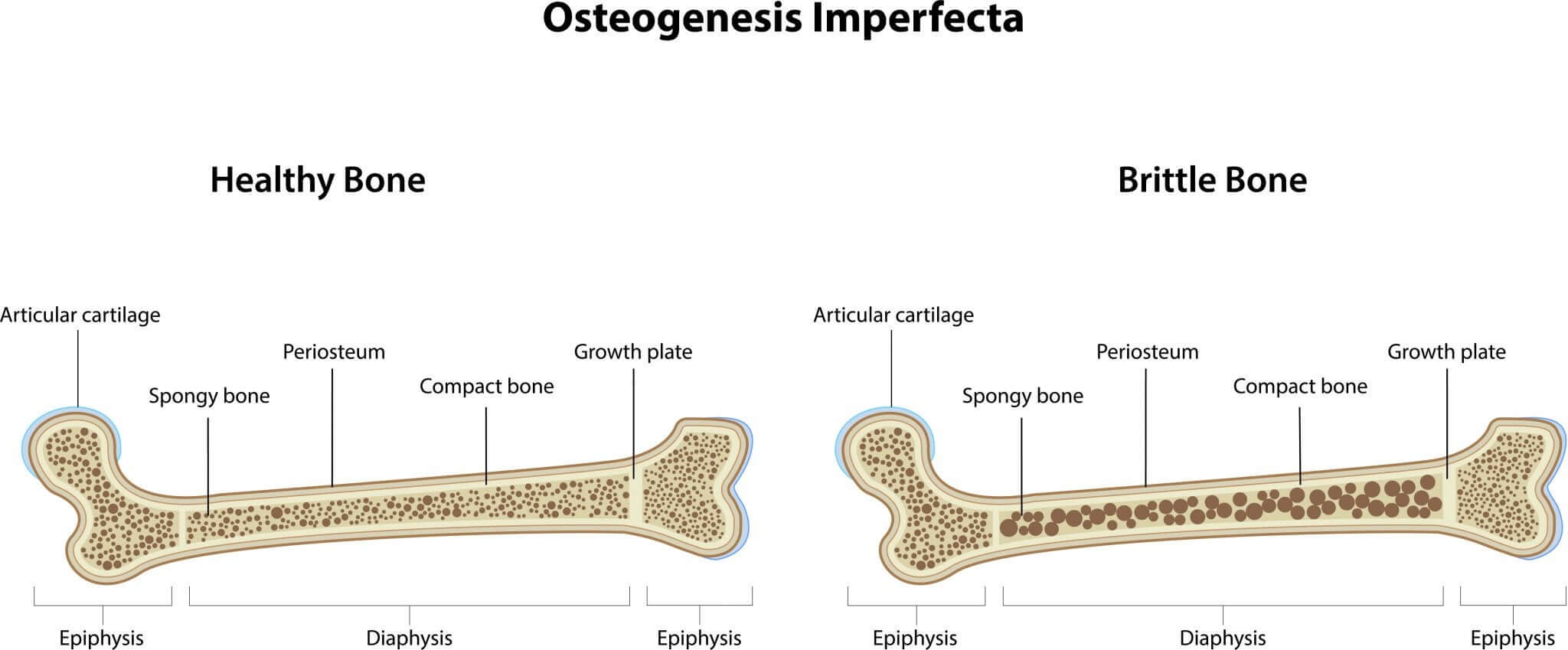 Osteogenesis Imperfecta in Children