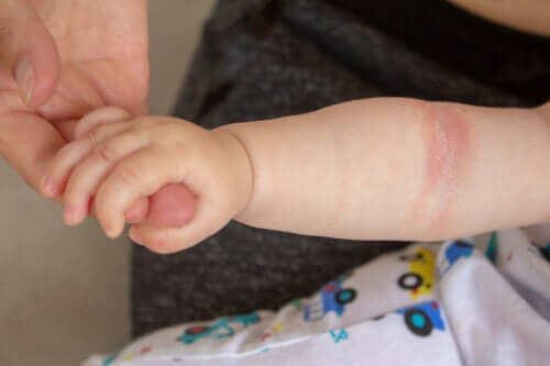 The Relationship Between Food and Eczema in Babies