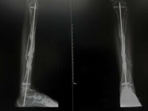 Osteogenesis Imperfecta in Children