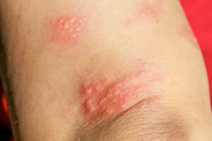 Gestational Pemphigoid During Pregnancy